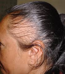 alopecia da extension