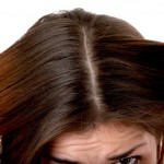 Perdita dei capelli: Forfora