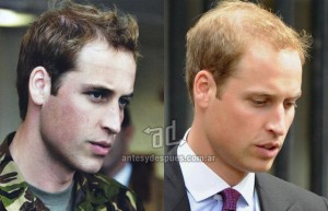 Prince William perdita dei capelli