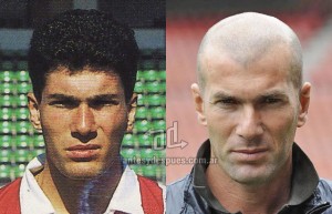 Zinedine-Zidane perdita dei capelli